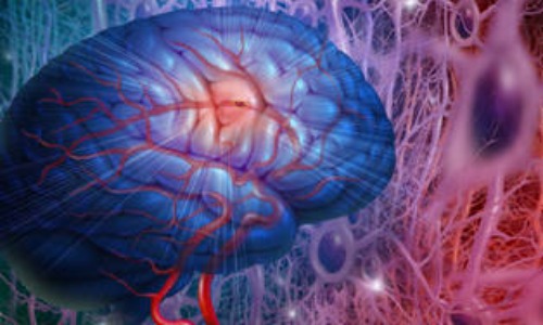 ¿Cómo prevenir un ataque cerebro vascular?