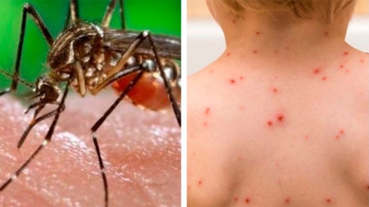 Dengue y Sarampión: crecen bajo la sombra del Coronavirus